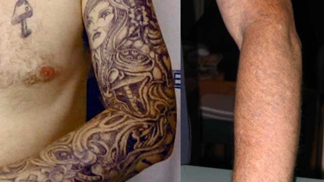 Laser Tattoo Removal Can Be A Cool Solution