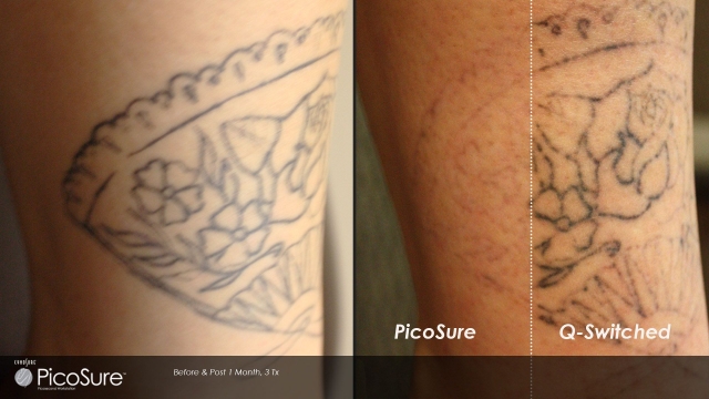 Tattoo Removal Options – Available To Be Able To Remove It