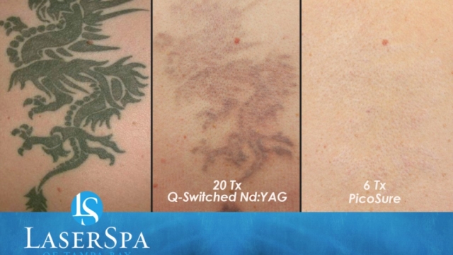 Four Facts You Absolutely Should Anticipate Before You Undertake Tattoo Laser Removal