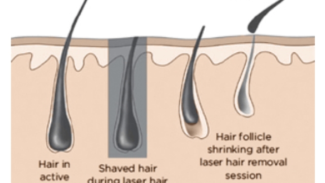 Laser Hair Removal: Unlocking the Secret to Smooth, Silky Skin