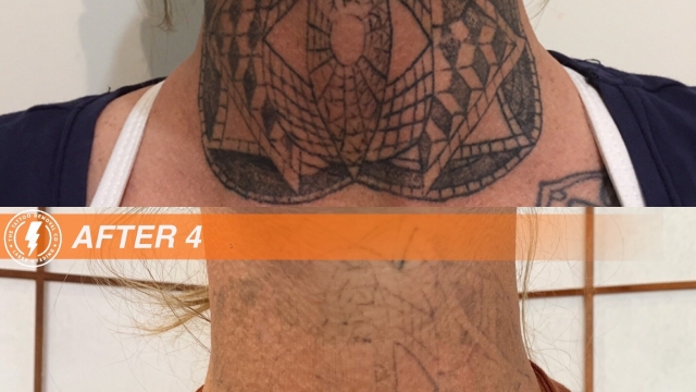 Tattoo Removal By Laser – Are You Certain This Is The Method You Want To Use?