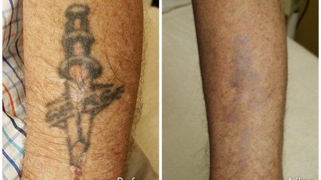 Tattoo Removal – Types Of Your Unwanted Tattoo