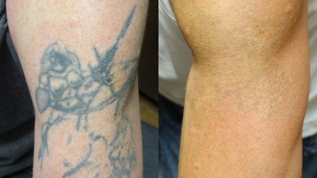 Tca Tattoo Removal & Potential Scarring If It’s Not Used Correctly