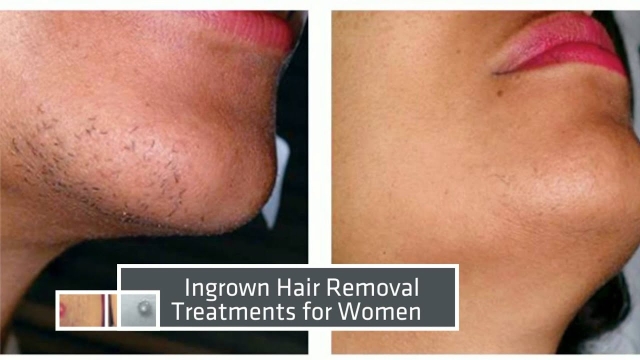 Smooth and Silky: Unveiling the Magic of Laser Hair Removal